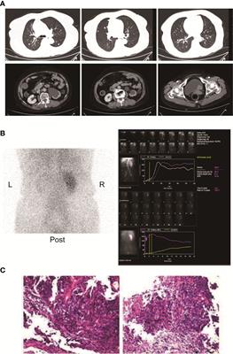 A PD-1 Inhibitor Induces Complete Response of Advanced Bladder Urothelial Carcinoma: A Case Report